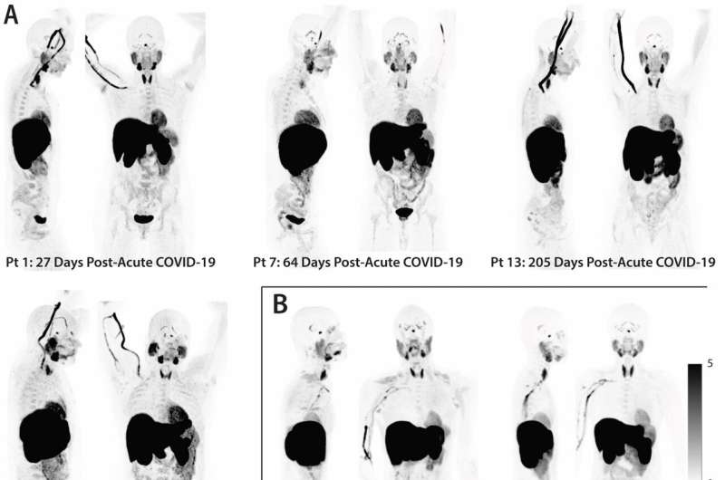 Long COVID uncharacteristic immune cell activity and SARS-CoV-2 RNA in the gut seen two years after infection